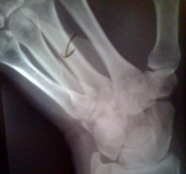 X-ray